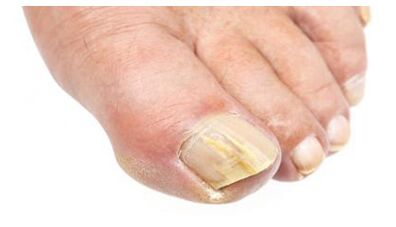 mycosis of the feet and nails